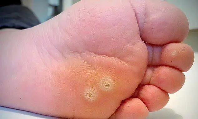 Mụn cóc là gì? Nguyên nhân, các loại thường gặp và cách chăm sóc tại nhà.