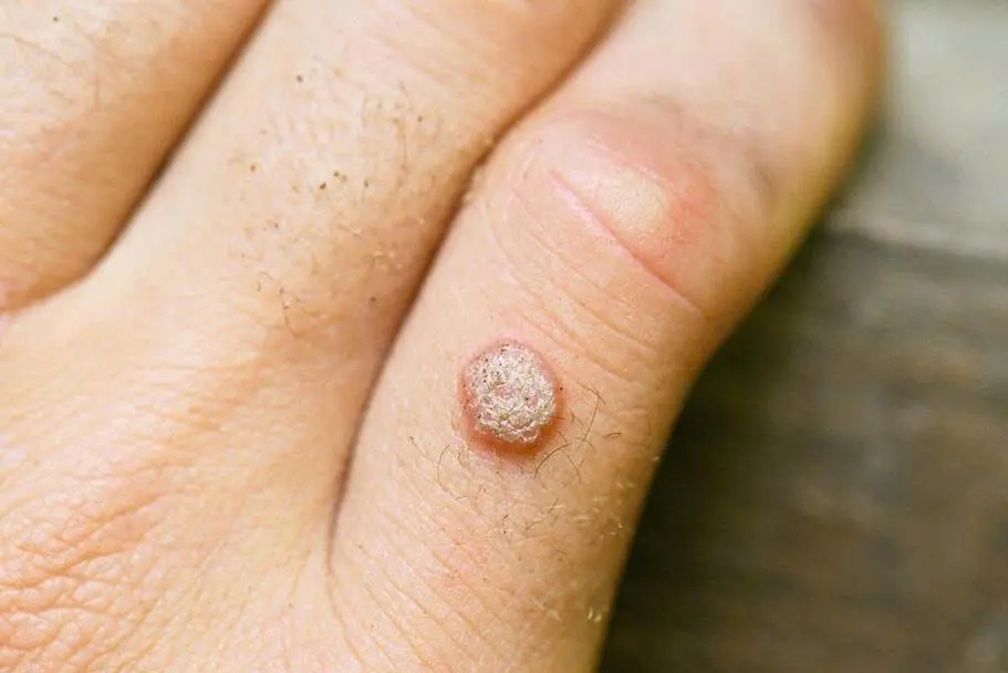 Mụn cóc là gì? Nguyên nhân, các loại thường gặp và cách chăm sóc tại nhà.
