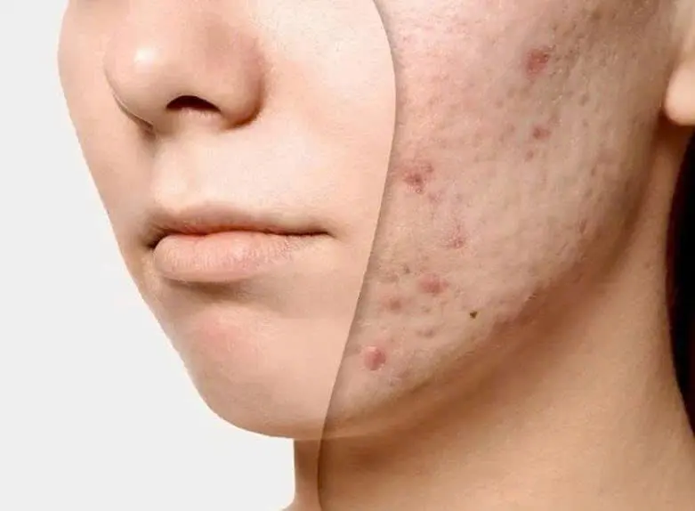 Nốt sần trên da: Nguyên nhân, dấu hiệu và cách xử lý