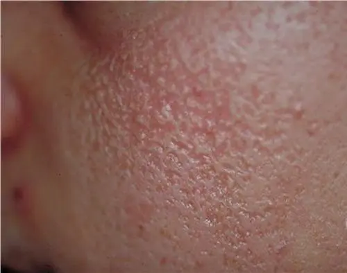 Bí quyết chăm sóc vùng da tăng sừng đúng cách