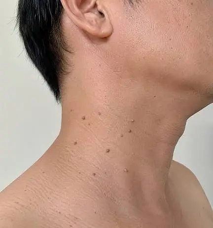 Mụn thịt thừa ở cổ: Nguyên nhân, cách điều trị và phòng tránh