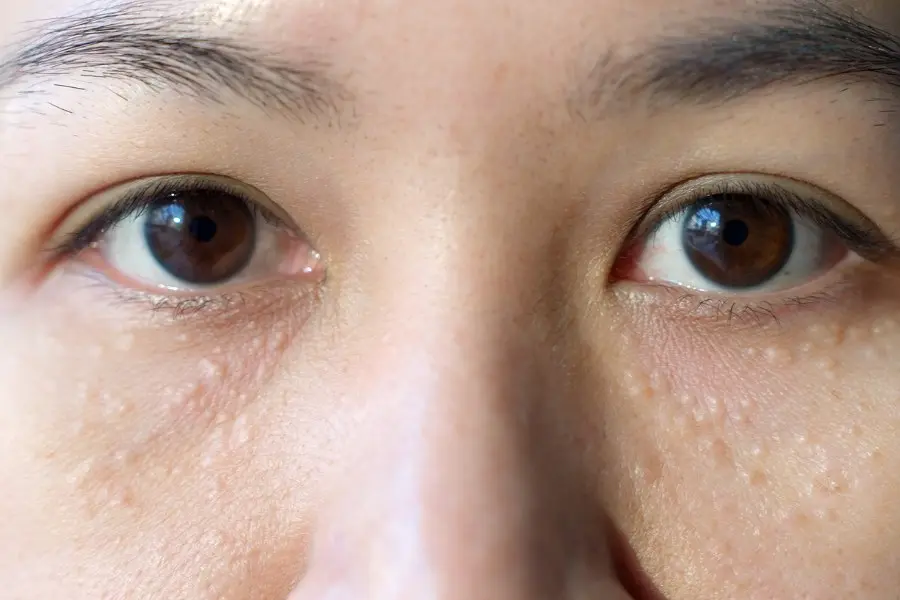 MỤN LI TI QUANH MẮT: NGUYÊN NHÂN VÀ CÁCH KHẮC PHỤC TRIỆT ĐỂ