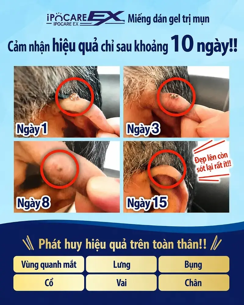 Thuốc trị mụn cóc: Các lựa chọn phổ biến và lưu ý khi sử dụng